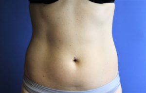 CoolSculpting® Before and After Pictures Midland, MI