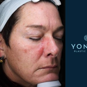 Laser Skin Rejuvenation Before and After Pictures Midland, MI