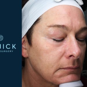 Laser Skin Rejuvenation Before and After Pictures Midland, MI