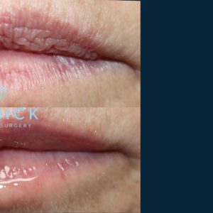 Juvéderm® Before and After Pictures Midland, MI