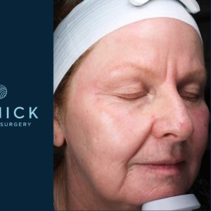 Laser Skin Rejuvenation Before and After Pictures Midland, MI