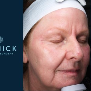 MicroLaser® Peel Before and After Pictures Midland, MI