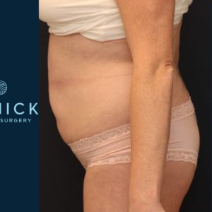 Allura™ Laser Body Sculpting Before and After Pictures Midland, MI