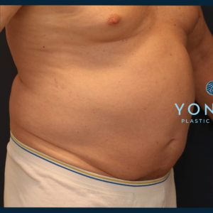 CoolSculpting® Before and After Pictures Midland, MI