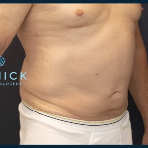 CoolSculpting® Before and After Pictures Midland, MI