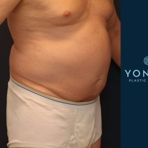 CoolSculpting® Before and After Pictures Midland, MI