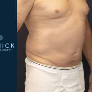 CoolSculpting® Before and After Pictures Midland, MI