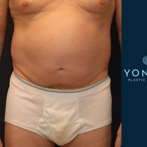 CoolSculpting® Before and After Pictures Midland, MI