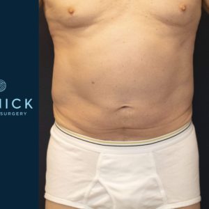 CoolSculpting® Before and After Pictures Midland, MI