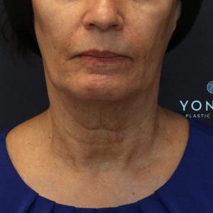 BOTOX® Before and After Pictures Midland, MI