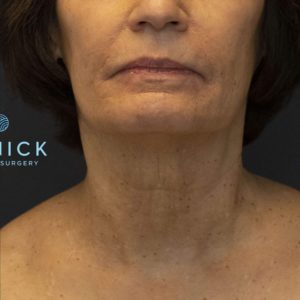 BOTOX® Before and After Pictures Midland, MI