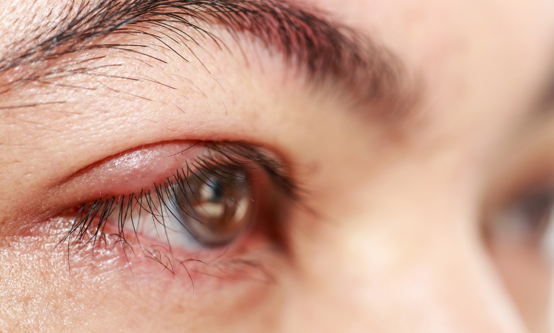 Is Laser Blepharoplasty Better? A Look into Traditional vs. Laser Eyelid Surgery