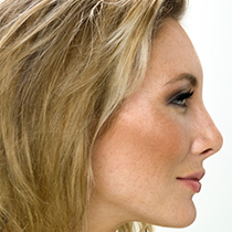 Non-Surgical Rhinoplasty in Midland, MI